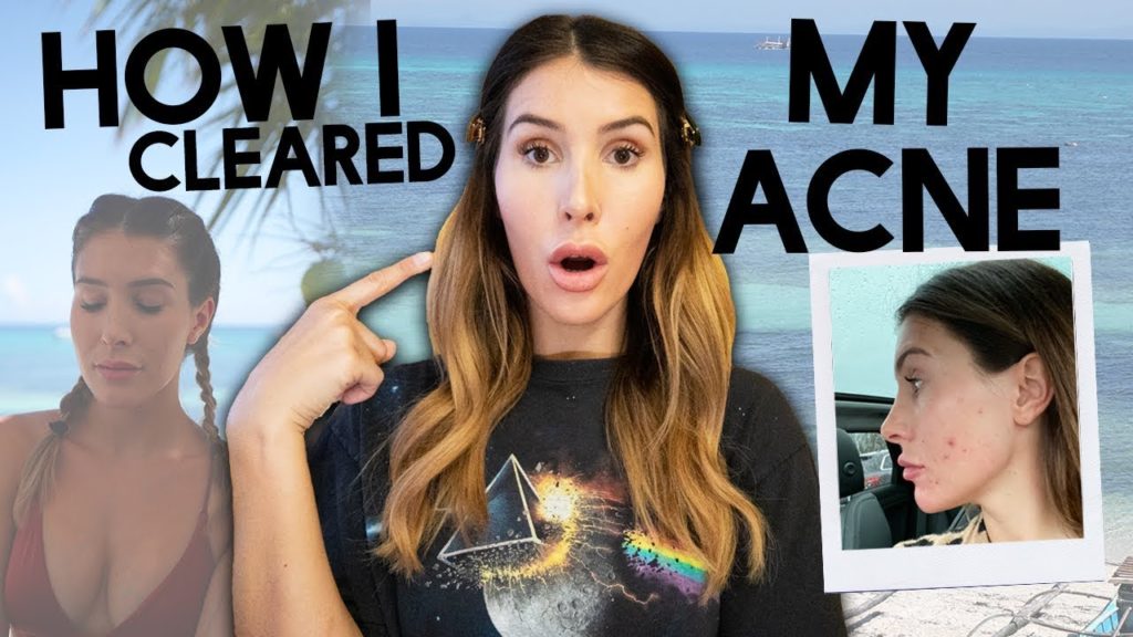 TRAVEL MAKEUP ROUTINE (And How I Finally Cleared My Acne) TRAVEL MAKEUP ROUTINE (And How I Finally Cleared My Acne)