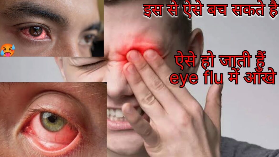 Eye flu में ऐसे हो जाती है आँखे और आखीर ये कैसे फैलता हैं Eye flu में ऐसे हो जाती है आँखे और आखीर ये कैसे फैलता हैं