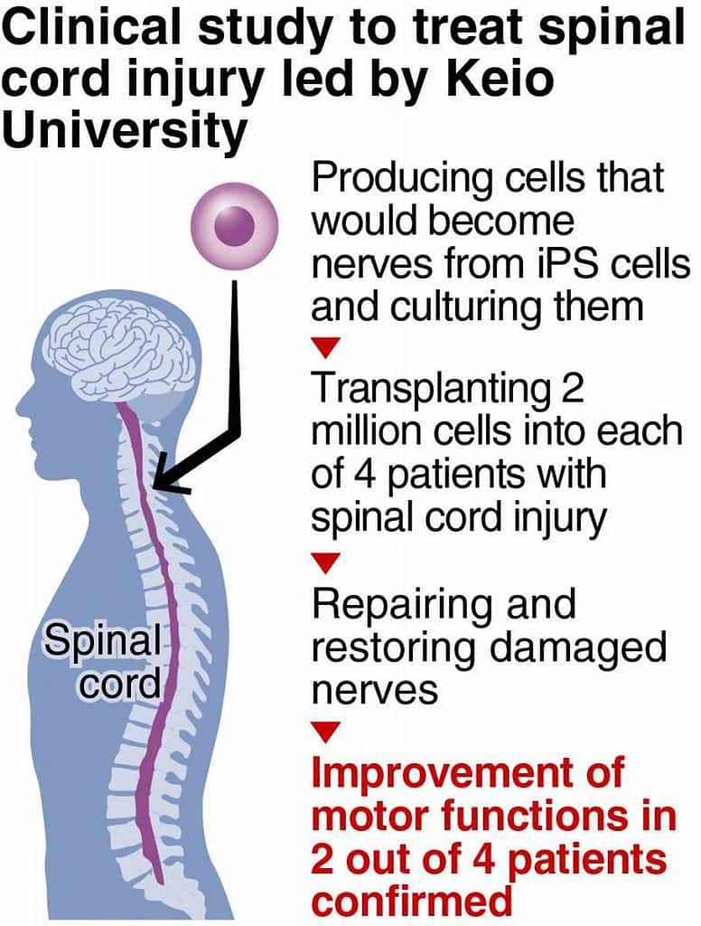 Infographic about the stem cell surgery on the paralyzed patients