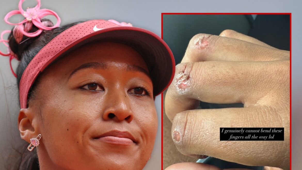 Naomi Osaka Shows Off Gnarly Blisters, Opens Up On Wanting Tennis Break