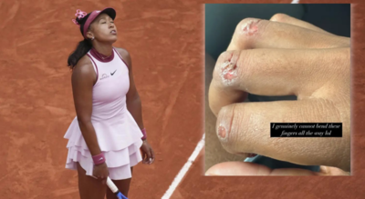 Naomi Osaka shows off gnarly blisters, says “I can’t bend my fingers,” hints at tennis break