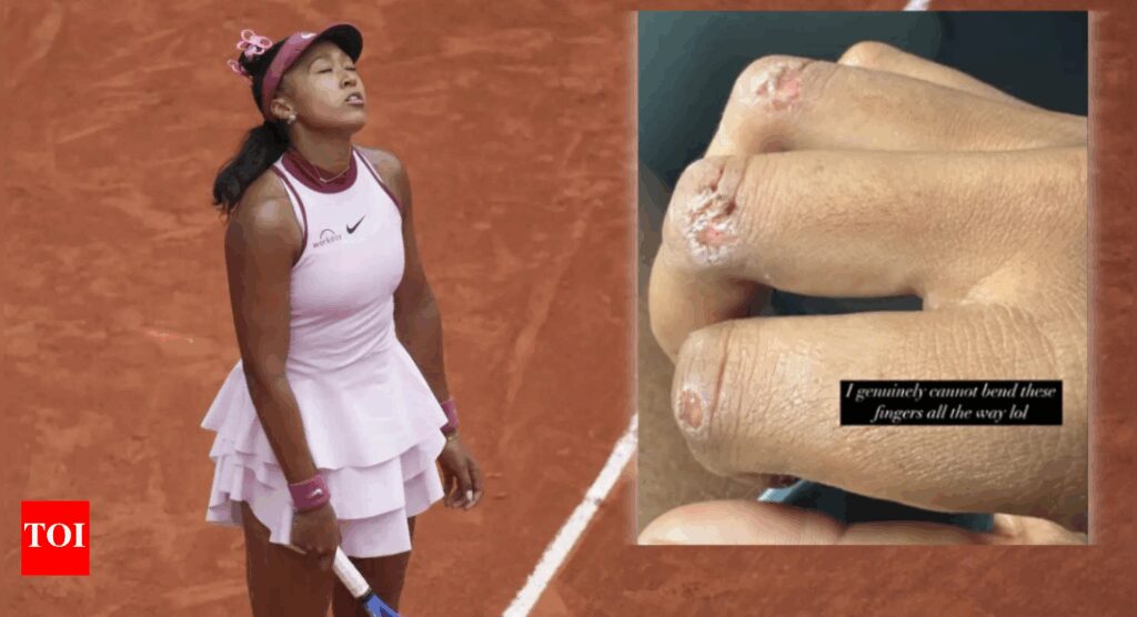 Naomi Osaka shows off gnarly blisters, says “I can’t bend my fingers,” hints at tennis break | International Sports News Naomi Osaka shows off gnarly blisters, says “I can’t bend my fingers,” hints at tennis break | International Sports News