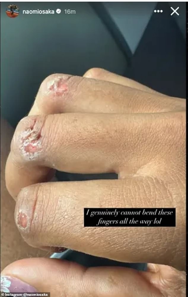 Naomi Osaka shared a gruesome picture of her blisters after her French Open loss