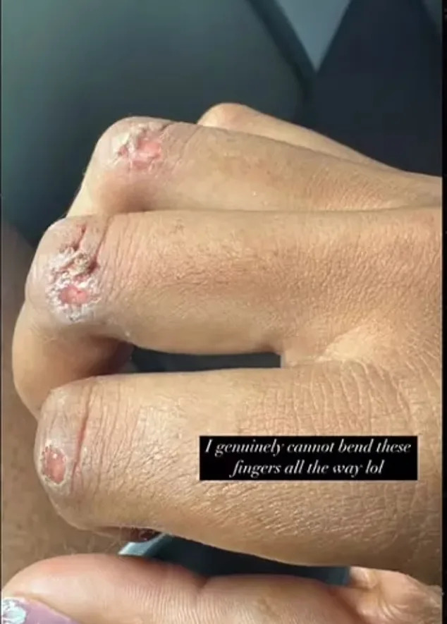 Naomi Osaka revealed a cluster of blisters on her hand after her disappointing first-round exit at the 2025 French Open, losing to Spain’s Paula Badosa on May 26, 2025. naomiosaka/Instagram