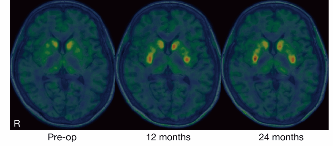 Japan’s Stem Cell Scientists Claim Breakthrough in Parkinson’s Treatment Japan’s Stem Cell Scientists Claim Breakthrough in Parkinson’s Treatment