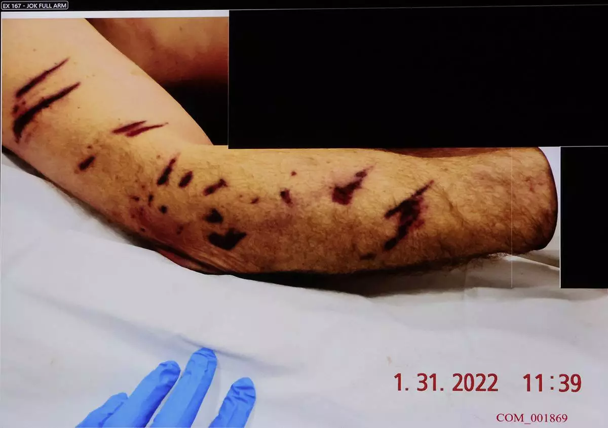 A photograph of John O'Keefe's right arm is republished during the murder retrial of Karen Read in Norfolk Superior Court, Monday, June 2, 2025, in Dedham, Mass. (Pat Greenhouse/The Boston Globe via AP, Pool)