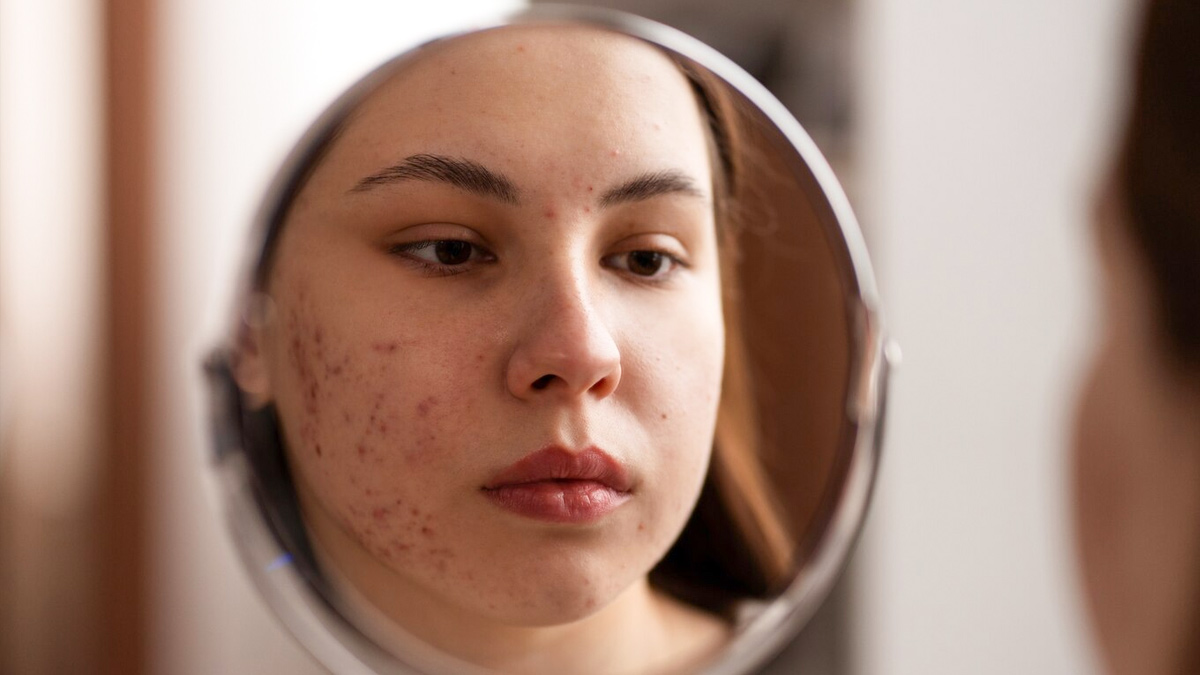 acne