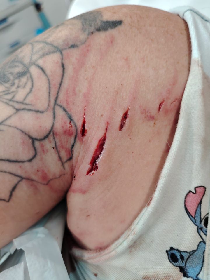Dog bite wounds on a person's arm.