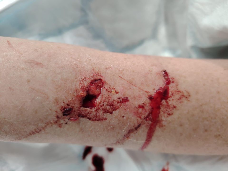 Severe dog bite wound on a woman's arm.