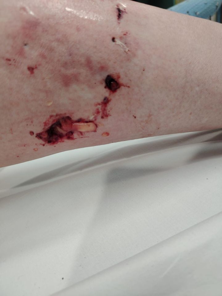 Severe dog bite wounds on a leg.