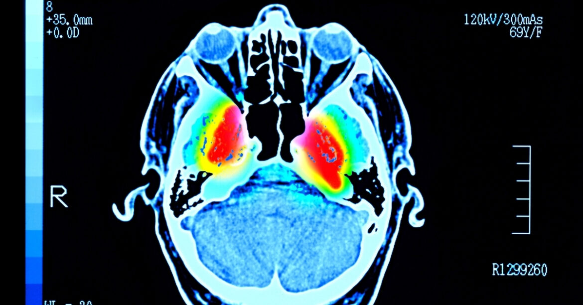 Japan’s Pharma Leader Seeking Approval for New Parkinson’s Treatment Japan’s Pharma Leader Seeking Approval for New Parkinson’s Treatment