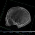 4,000-year-old Egyptian skull