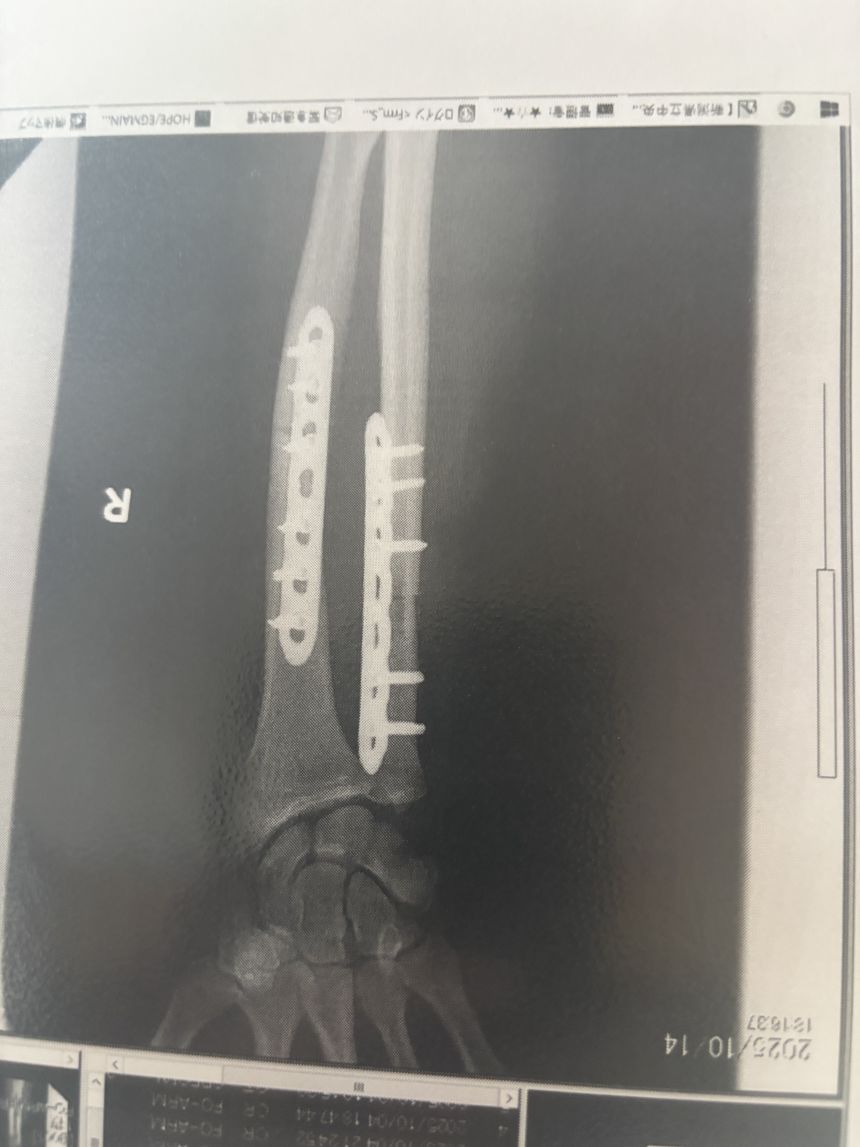 Halloran’s injuries required three surgeries, including a hip bone graft and the insertion of plates in his arm.
