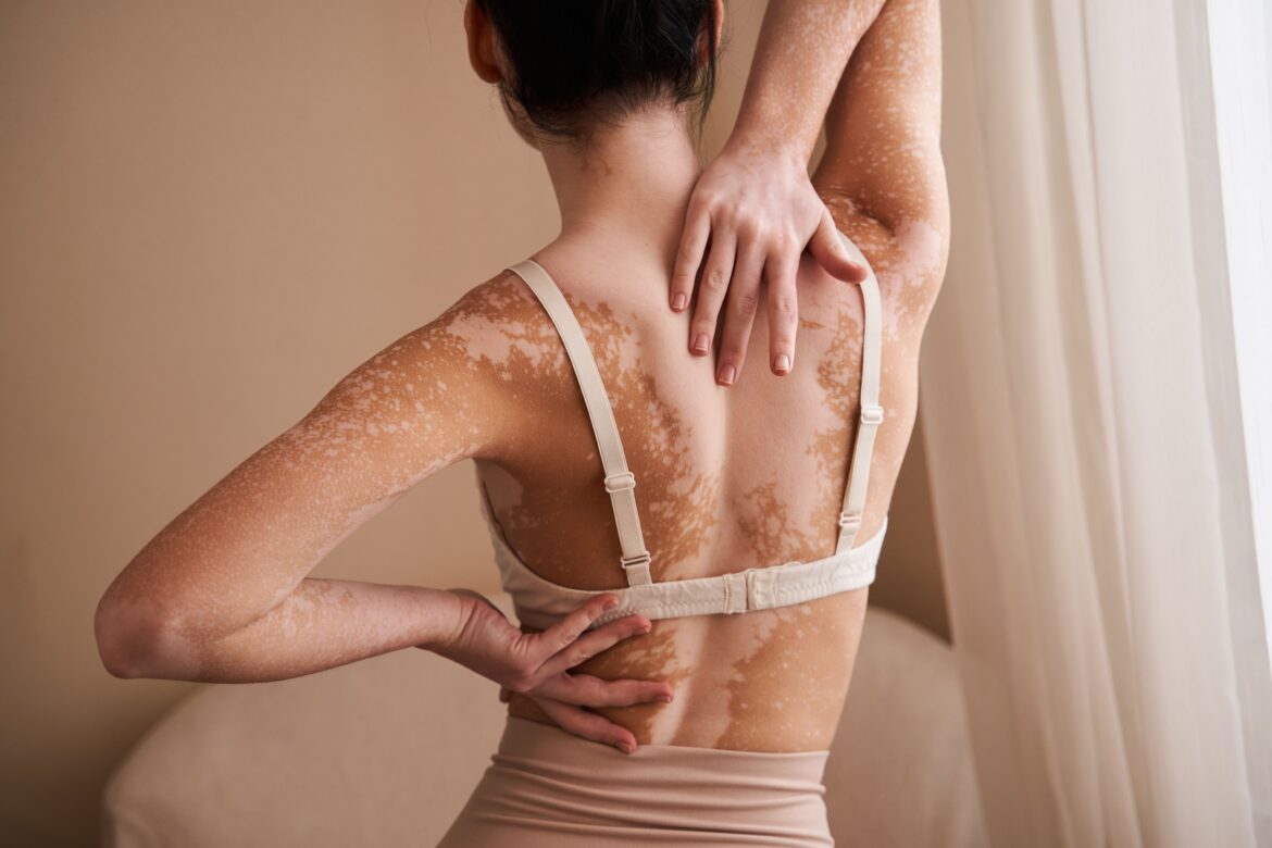 Impaired HRQoL and High Psychological Comorbidity Observed in Japanese Vitiligo Patients Impaired HRQoL and High Psychological Comorbidity Observed in Japanese Vitiligo Patients