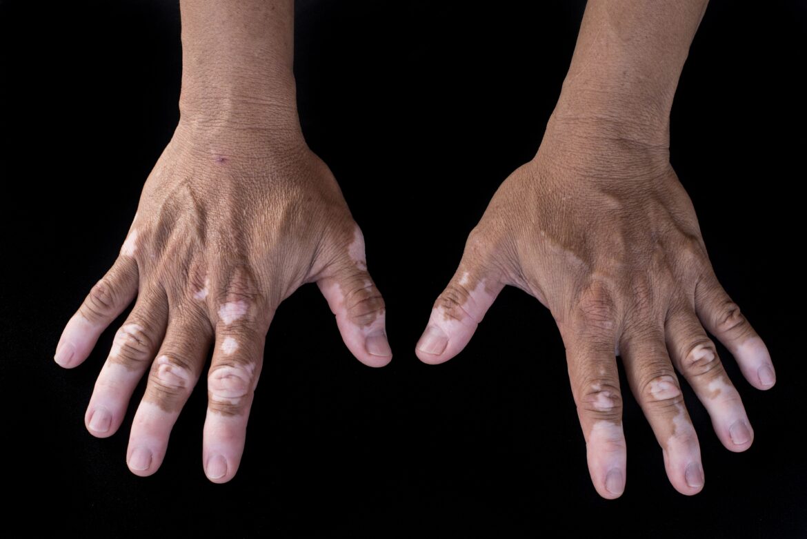 Japanese study finds vitiligo has a strong impact on daily life and mental health Brand Logo