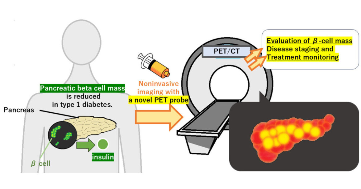 Bringing diabetes treatment into focus