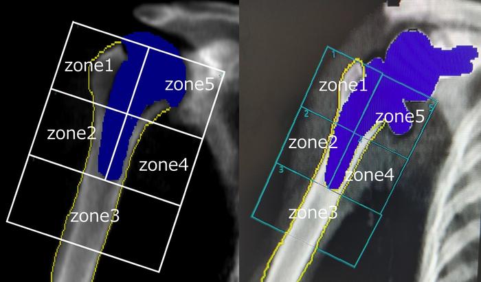 Postoperative aTSA and RSA DEXA findings