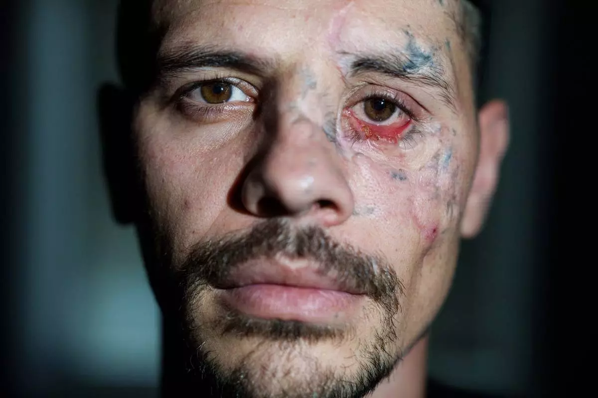 Wounded soldier Artem Deresh poses for a photo before undergoing surgery at a regional hospital in Kyiv, Ukraine, Monday, Sept. 28, 2026. (AP Photo/Evgeniy Maloletka)